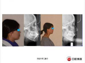 成人拔牙原视频,从术前准备到术后护理